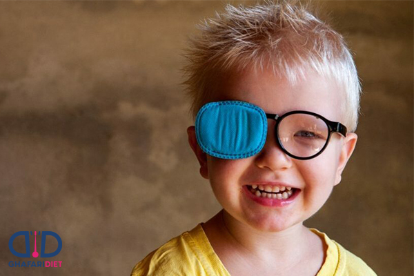 درمان تنبلی چشم در کودکان