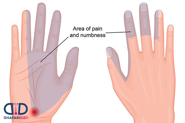 علائم سندروم تونل کارپال