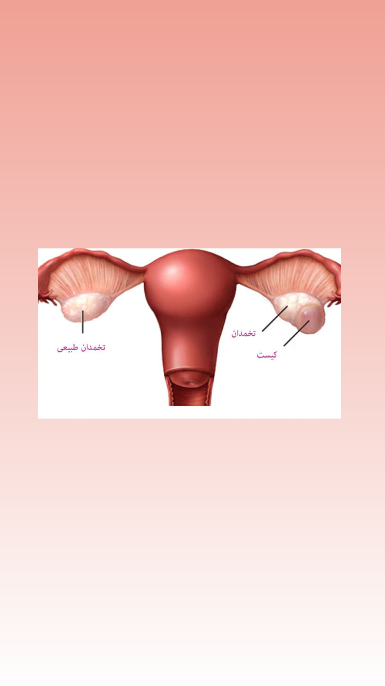 علائم و راه های درمان کیست تخمدان 