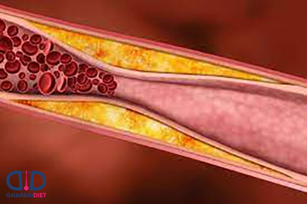 انواع چربی خون چیست؟ کدام نوع چربی خون خطرناک است