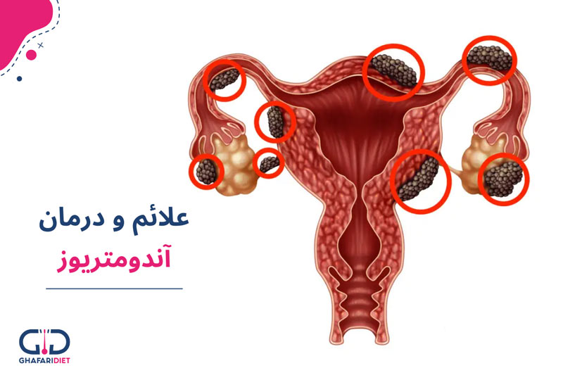 آندومتریوز؛ از تشخیص تا درمان