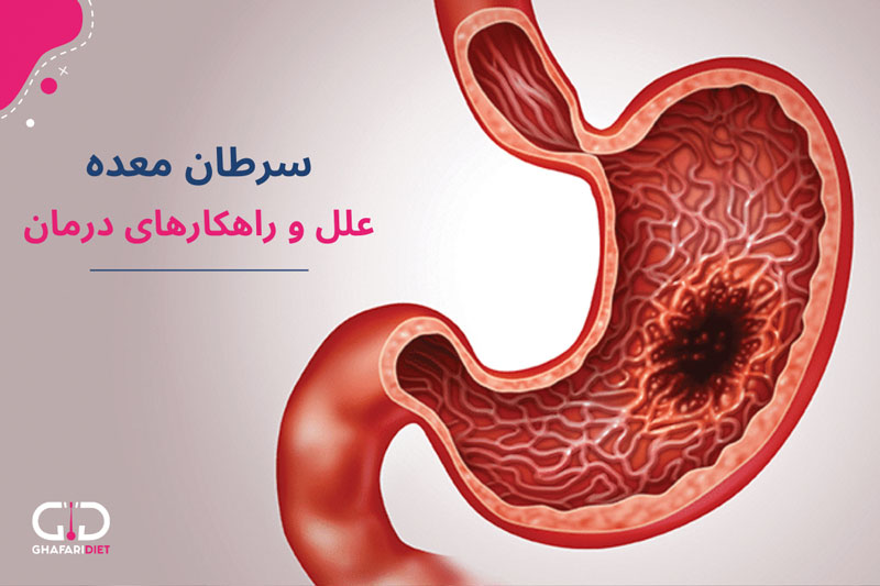 سرطان معده: علل، علائم و راهکارهای تشخیص و درمان 