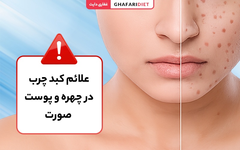 علائم کبد چرب در چهره و پوست صورت [هشدار جدی!!!]