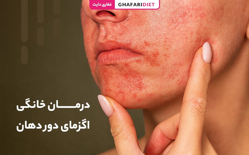 6 درمان خانگی اگزمای دور دهان + دلایل و علایم