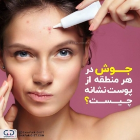 .
?جوش در هر منطقه از پوست نشانه چیست

1️⃣ پیشانی
? مشکل گوارشی و مصرف فست فودها را نشان میدهد

2️⃣ وسط ابروها
? مشکل از کبد و مصرف غذاهای چرب است

3️⃣ اطراف چشم
? مشکل در کلیه است که با نوشیدن آب به اندازه کافی تا حدی برطرف می شود

4️⃣ گونه 
? مشکل سیستم تنفسی و آلرژی است که به حذف مصرف سیگار و رعایت کردن برنامه غذایی مناسب برای آلرژی برطرف می شوند

5️⃣بینی 
? باید مراقب قلب خود باشید و ویتامین B بیشتر مصرف کنید

6️⃣ چانه و اطراف لب 
? اختلالات هورمون و وجود استرس است

7️⃣گوش ها 
? مشکل کلیه باعث بروز این مشکل است
_______________________________________
?لطفا نام و نام خانوادگی خود را به شماره 30005905 پیامک کنید تا در قرعه کشی ماهانه شرکت داده شوید.

@ghafaridiet 
______________________________________
❌لطفا بدون ذکر منبع از پست ها استفاده نشود❌
.
#گیاهی #کاهش_وزن #افزایش_وزن #رژیم_چاقی #رژیمی #رژیم_لاغری #رژیم #چاقی #لاغری #تناسب_اندام #غذای_سالم #غفاری_دایتی #غفاری_دایت #چربی #متابولیسم #جوش #قدرت#اضافه_وزن#چاق #ویتامین
#دایت #تغذیه_مناسب 
#ghafaridiet #diet #healthyfood #healthy #healthylifestyle #fat