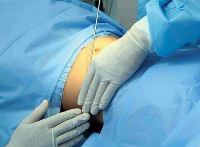 رژیم لاغری یا عمل جراحی؟