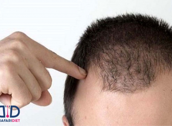 راهکارهای موثر برای جلوگیری از ریزش مو !