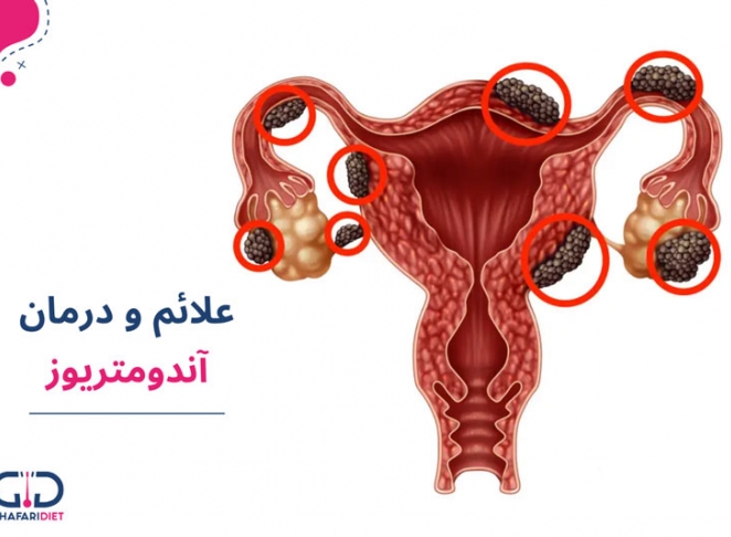 آندومتریوز؛ از تشخیص تا درمان