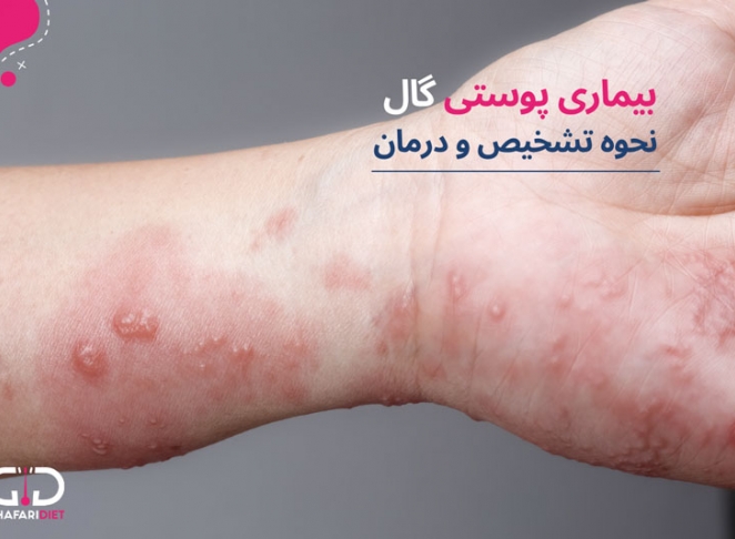 بیماری پوستی گال، تشخیص و درمان آن