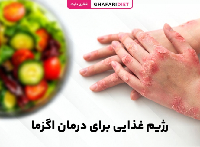 رژیم غذایی برای درمان اگزما [16 ماده غذایی ضد اگزما]