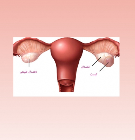 علائم و راه های درمان کیست تخمدان 