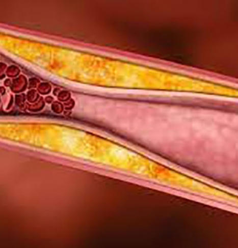 انواع چربی خون چیست؟ کدام نوع چربی خون خطرناک است
