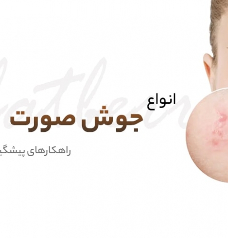 جوش صورت: انواع، علل و درمان‌های موثر + راهکارهای پیشگیری