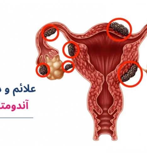 آندومتریوز؛ از تشخیص تا درمان