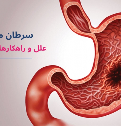 سرطان معده: علل، علائم و راهکارهای تشخیص و درمان 