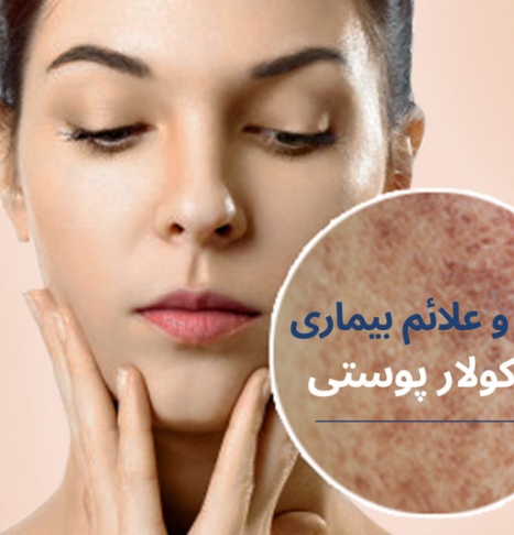 بیماری ماکولار یا آمیلوئیدوز پوستی چیست و چه درمانی دارد؟