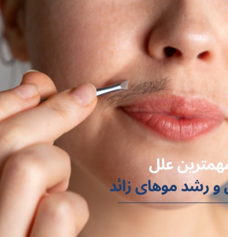 مهمترین دلایل رشد موهای زائد و پر مویی در زنان چیست؟