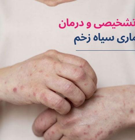 علائم بیماری سیاه زخم چیست؟ آیا درمان دارد؟