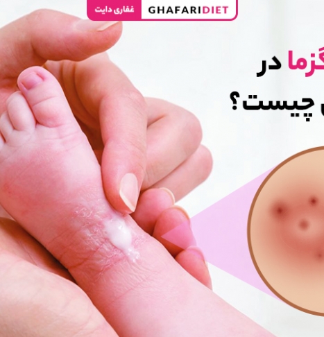 اگزما در نوزادان و کودکان چیست؟ 6 روش درمان