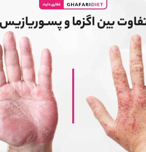 6 تفاوت بین اگزما و پسوریازیس چیست؟ نحوه تشخیص