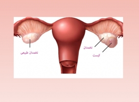 علائم و راه های درمان کیست تخمدان 