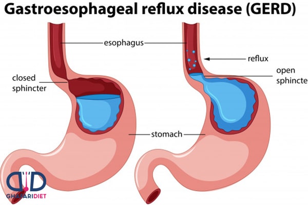 رفلاکس معده چه زمانی رخ می دهد