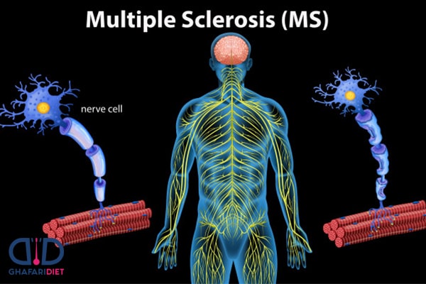 علت بوجود آمدن بیماری ام اس چیست