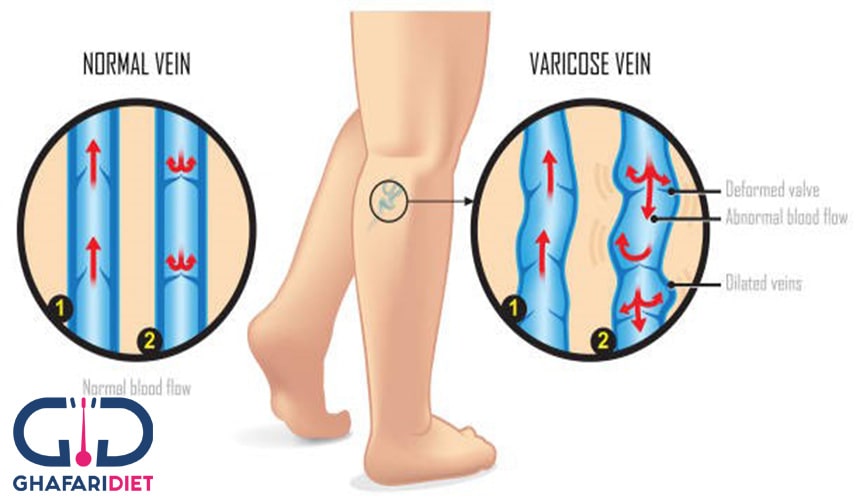 درمان واریس پا