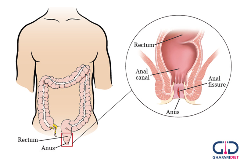درمان شقاق مقعدی