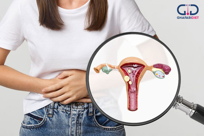آندومتریوز و ناباروری