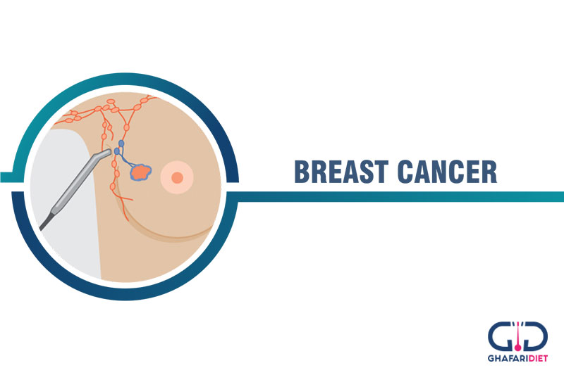 انواع سرطان سینه